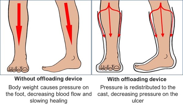 3. Offloading a diabetic foot ulcer (adapted, Diabetic Foot Guardian)