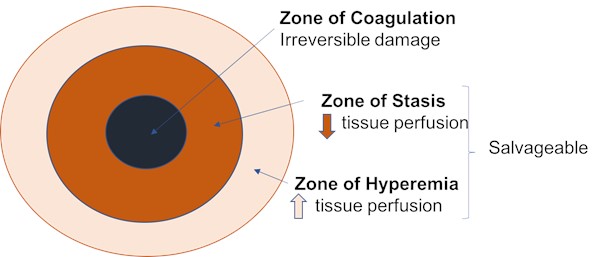 Acute burns - Jackson's zones