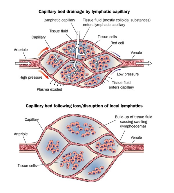 Pathogenesis of lymphedema