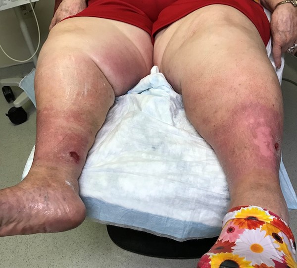 Lymphedematous leg with ulcers