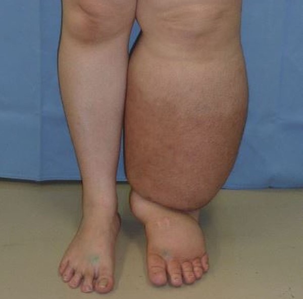 Right lower extremity lymphedema. By Medical Doctors