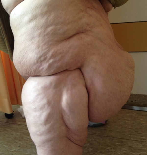 Lipedema. By Herecomesdoc [CC BY-SA 3.0 (https://creativecommons.org/licenses/by-sa/3.0)]