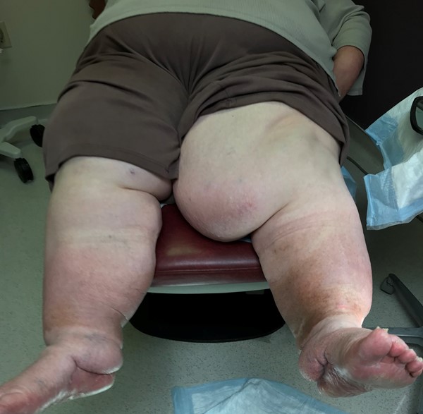 Lymphedema and obesity