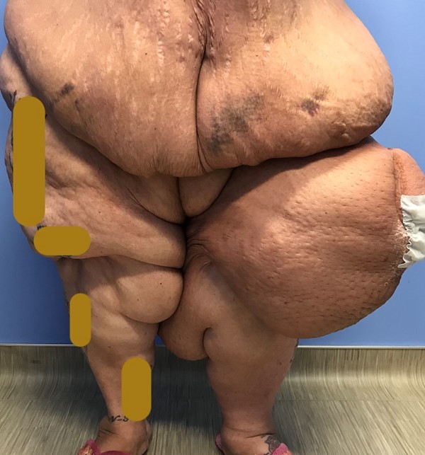 Lymphedema associated with obesity