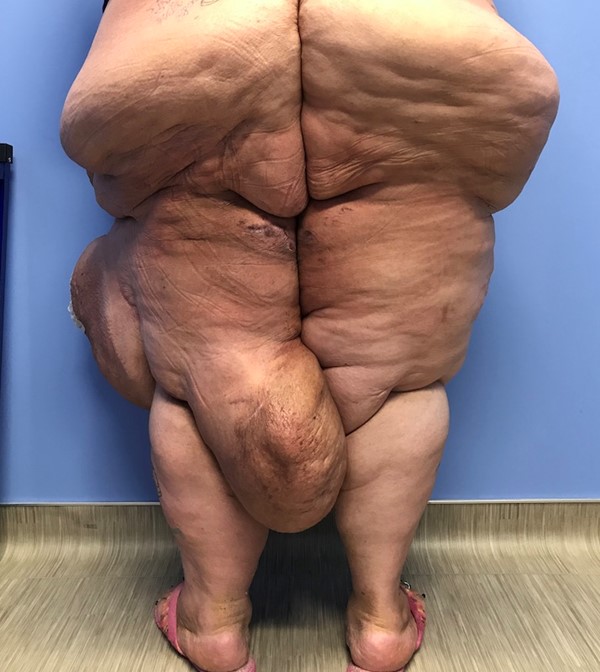 Lymphedema associated with obesity
