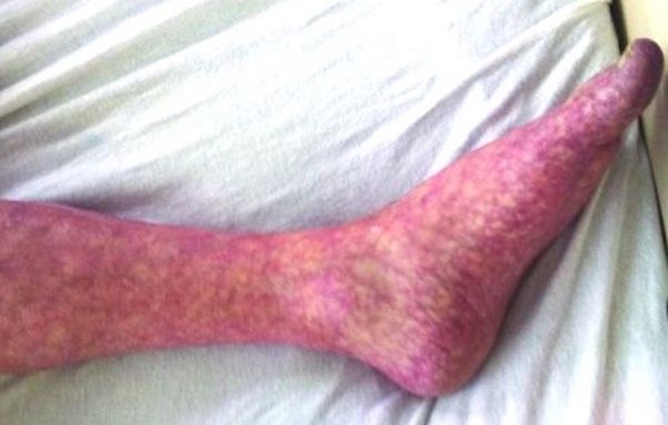 Livedo reticularis. By Nantsupawat T et al.