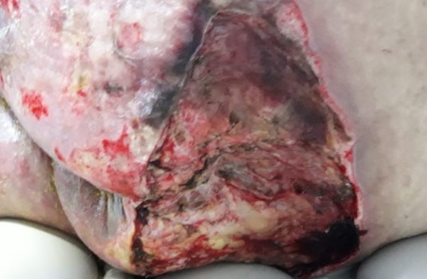 Wound bed post debridement of necrotic area