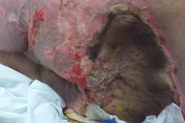 Progressive necrosis after debridement