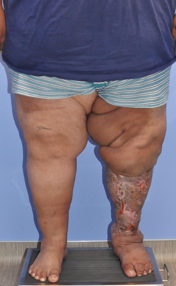 Charles procedure. Post-operative frontal view