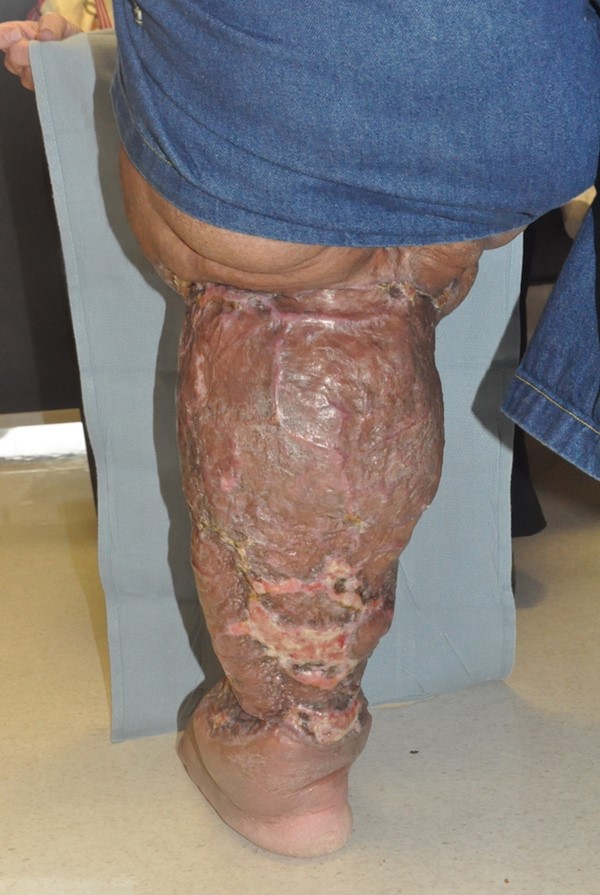 Charles procedure. Post-operative back view