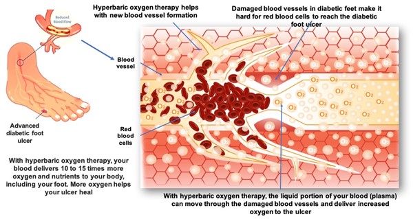 Effects of hyperbaric oxygen therapy on diabetic foot ulcer