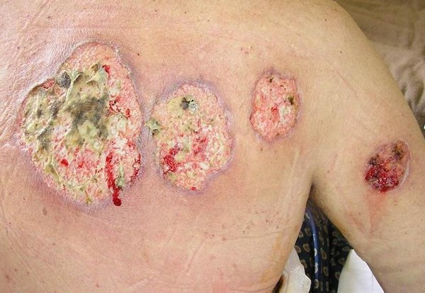 Ulcerative pyoderma gangrenosum on the back (I, Monopol [CC BY-SA 3.0]