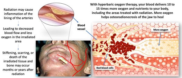Effects of hyperbaric oxygen therapy on ORN of the mandible. Picture by Worth E, M.D.