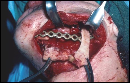 Mandibular reconstruction