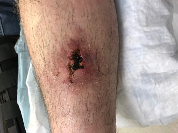 Necrotic lesion on the anterolateral aspect of the left leg
