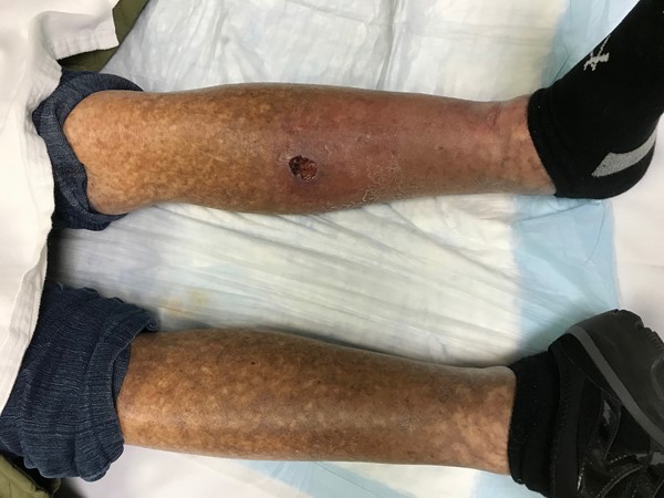 Livedo reticularis. By Robinson S, M.D.