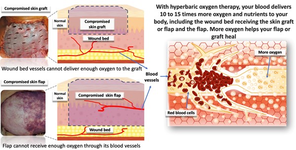 Effects of hyperbaric oxygen therapy on compromised graft and flap