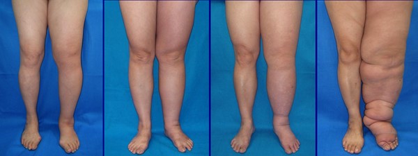 Lymphedema of the legs. DocHealer [CC BY-SA 4.0]