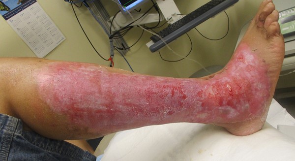 Partial thickness burn 1 week after conservative debridement. By Lebendiskaya N