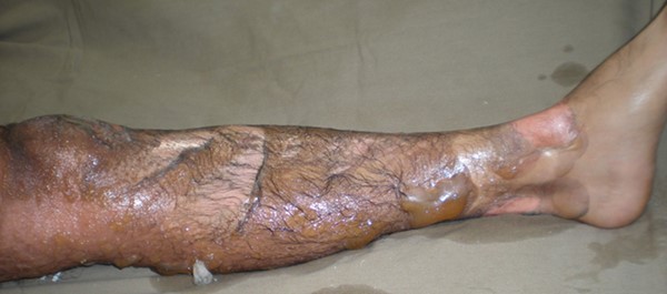 Partial thickness burn injury with bullae