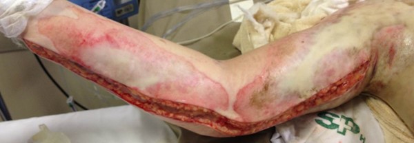 Escharotomy performed along the upper right extremity