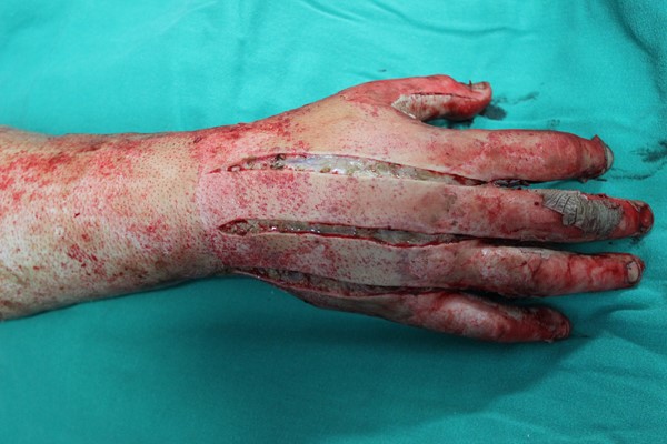 Escharotomy of the hand