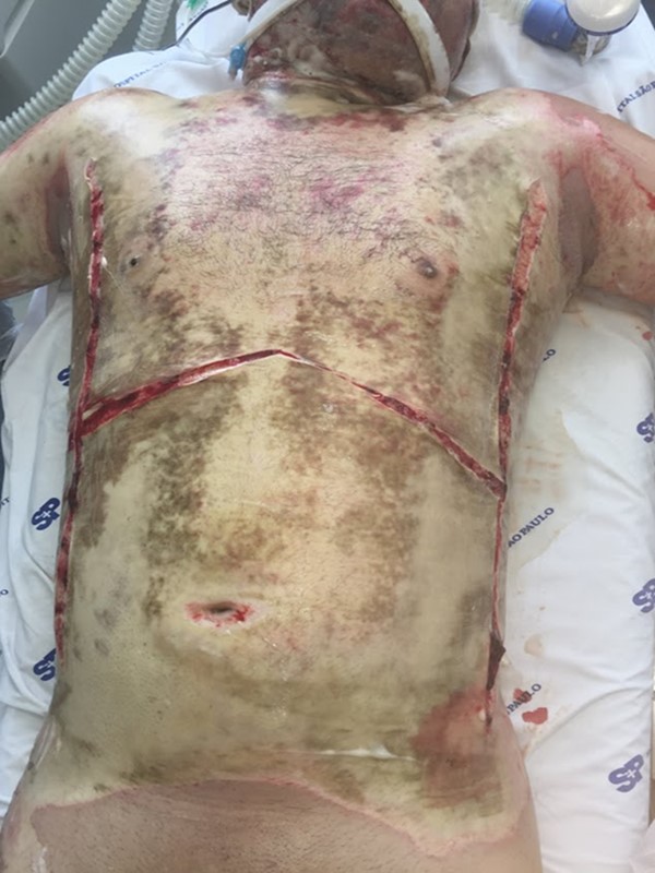Thoracic and abdominal escharotomy
