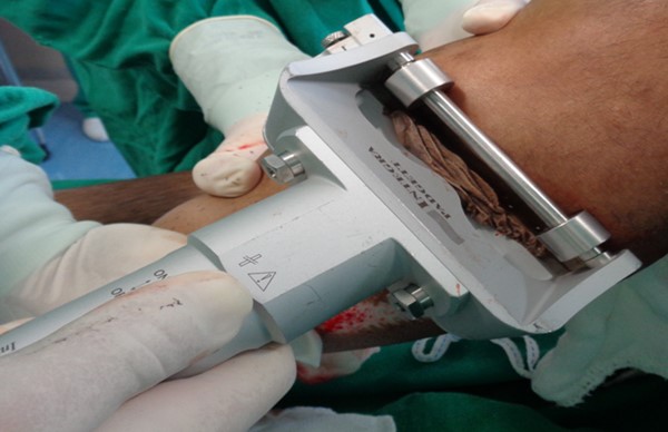  Dermatome. Harvest of a split-thickness skin graft