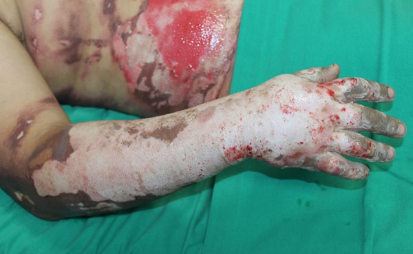 Full-thickness burn injury on right forearm and hand