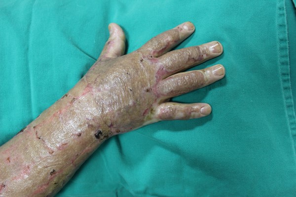 3 months after sheet split-thickness skin grafts