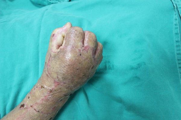 Range of motion preserved after sheet split thickness skin grafts