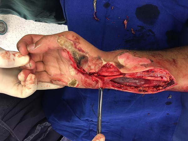 Fasciotomy was required to treat acute carpal tunnel syndrome due to compartment syndrome