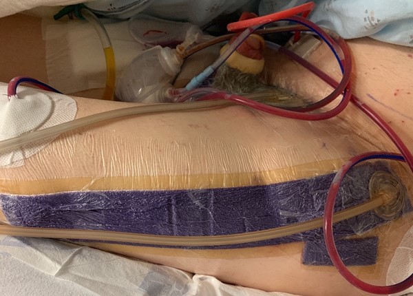 Circumferential NPWT to bolster skin graft in male genital reconstruction