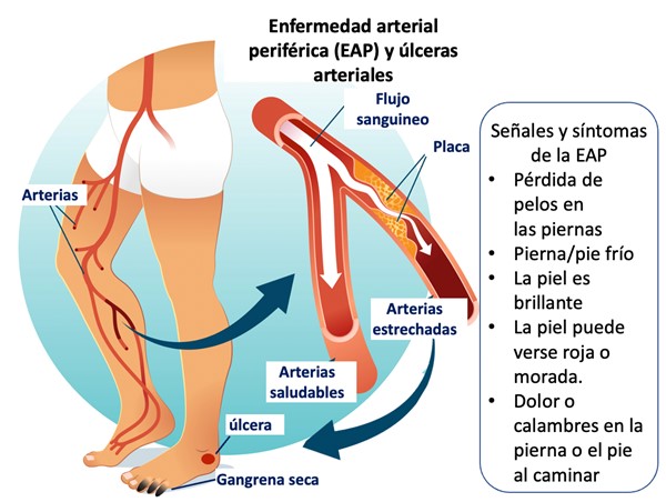 Enfermedad arterial periférica (EAP) causa la mayoría de las úlceras arteriales