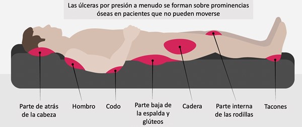 Ubicaciones comunes de úlceras/lesiones por presión