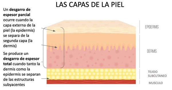 La gravedad de los desgarros de la piel puede variar según la profundidad  