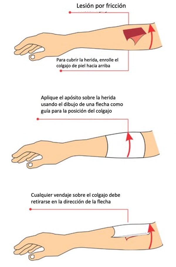 Protocolo de tratamiento para desgarros de piel
