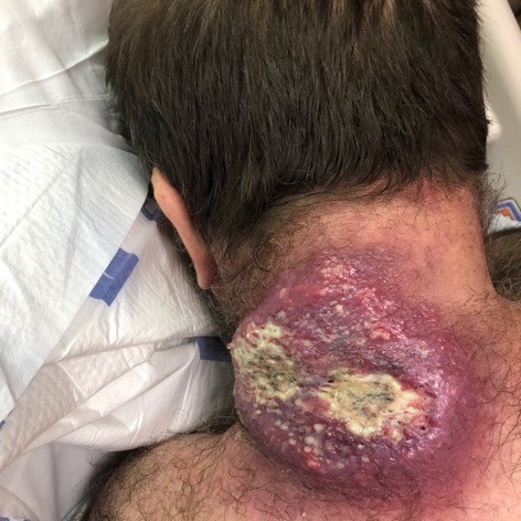 Large mass and abscess on the neck.