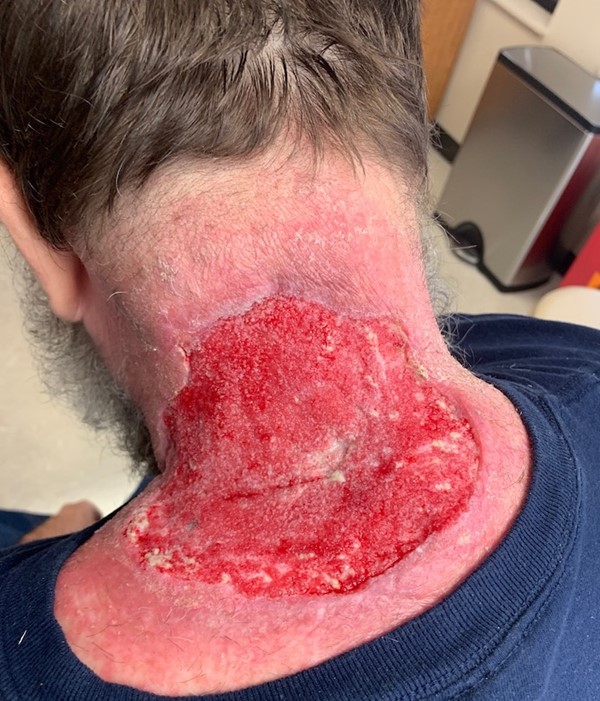 Signs of improvement of the wound after NPWT