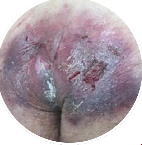 Figure: 3. Friction-induced skin injury 