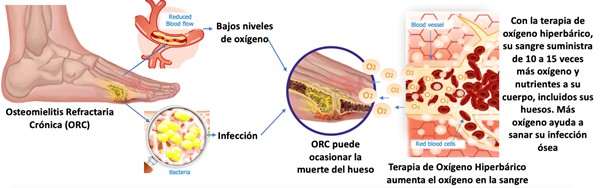 Efectos de la terapia de oxígeno hiperbárico en la osteomielitis refractaria