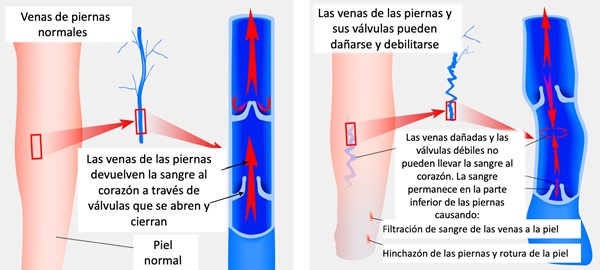 Válvulas de las venas en pierna normal y con insuficiencia venosa crónica