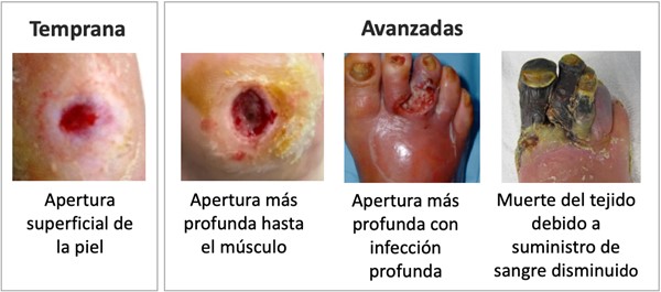 Etapas tempranas y avanzadas de las úlceras del pie diabético