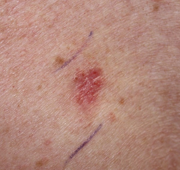 Superficial_basal_cell_carcinoma.jpeg