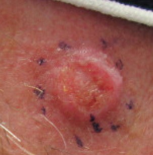 Squamous_Cell_Carcinoma,_Right_Upper_Cheek.png