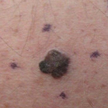 Primary skin cancer malignant melanomas.jpg