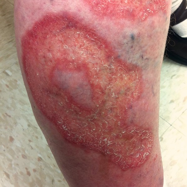 Ulcerative necrobiosis lipoidica.jpg