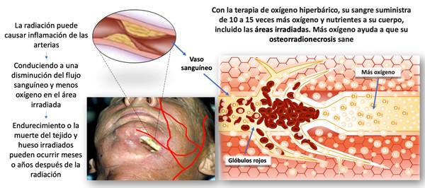 Efectos de la terapia de oxígeno hiperbárico en la osteorradionecrosis 