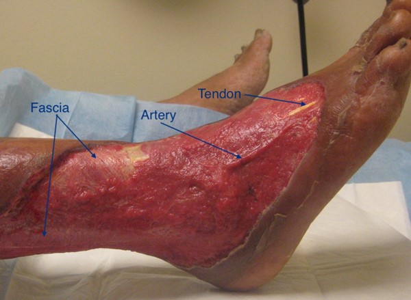 Traumatic wound with exposed fascia, artery, tendons