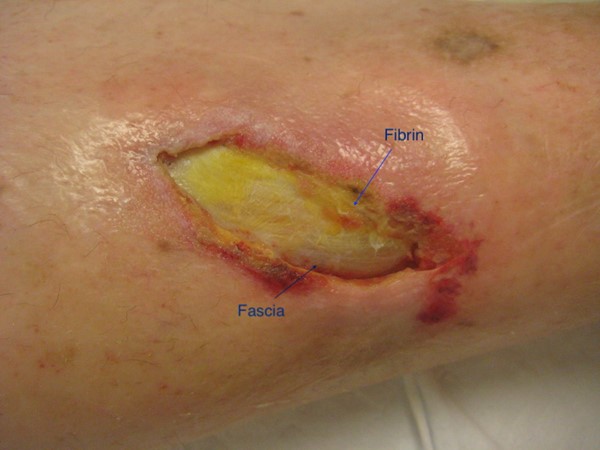 Wound bed with fibrin covering underlying fascia